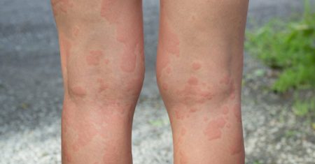 Chronic Urticaria from the patient perspective