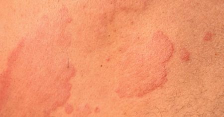 Missed Opportunities in Chronic Urticaria